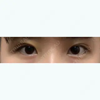 4日目の経過画像（1枚目）