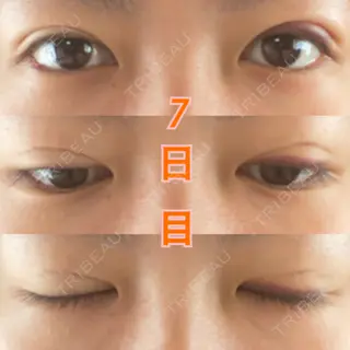 7日目の経過画像（1枚目）