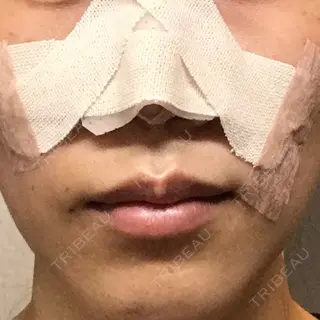 0日目の経過画像（2枚目）