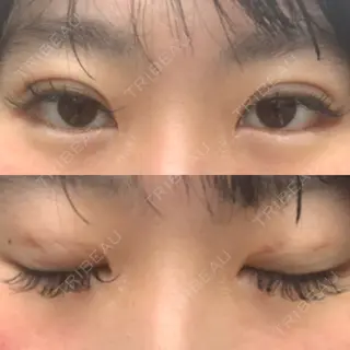 2日目の経過画像（1枚目）
