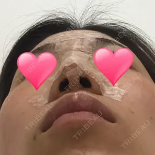 4日目の経過画像（1枚目）
