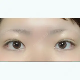 30日目の経過画像（1枚目）