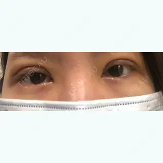 6日目の経過画像（1枚目）