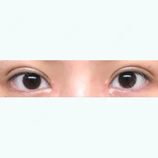 17日目の経過画像（1枚目）