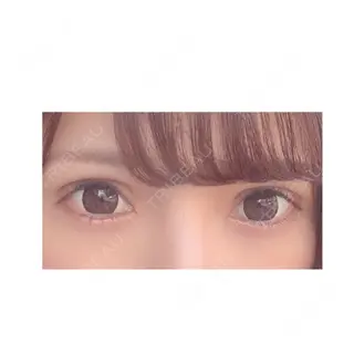 72日目の経過画像（2枚目）