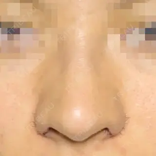6日目の経過画像（1枚目）