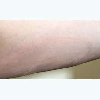 0日目の経過画像（3枚目）
