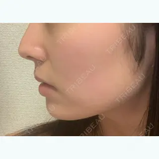 0日目の経過画像（3枚目）