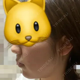 32日目の経過画像（1枚目）