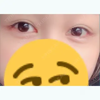 30日目の経過画像（3枚目）