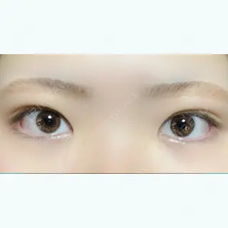 32日目の経過画像（1枚目）
