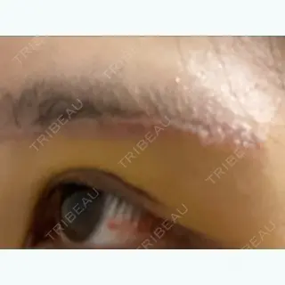5日目の経過画像（3枚目）