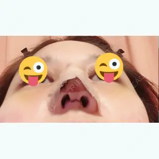 5日目の経過画像（2枚目）