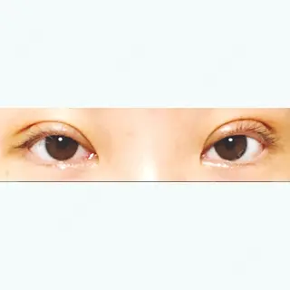 4日目の経過画像（1枚目）