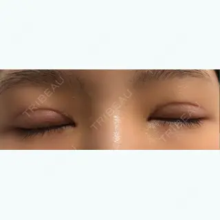 10日目の経過画像（2枚目）
