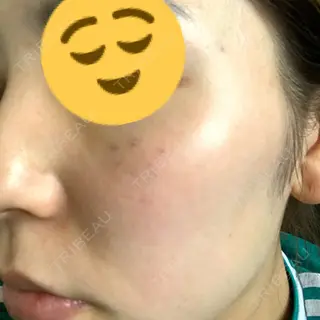 5日目の経過画像（1枚目）