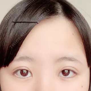 6日目の経過画像（1枚目）