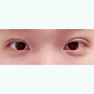 13日目の経過画像（1枚目）