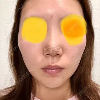3日目の経過画像（1枚目）