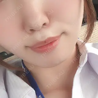 13日目の経過画像（1枚目）