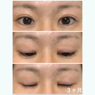 99日目の経過画像（1枚目）
