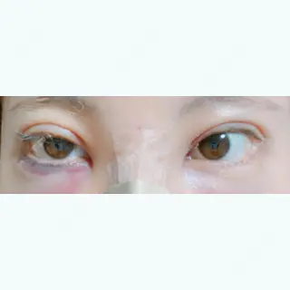 1日目の経過画像（1枚目）