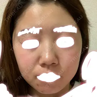 72日目の経過画像（1枚目）
