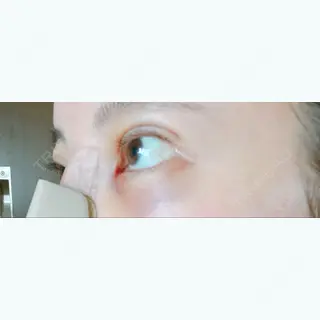 2日目の経過画像（3枚目）