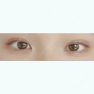 15日目の経過画像（1枚目）