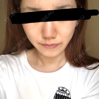 8日目の経過画像（2枚目）