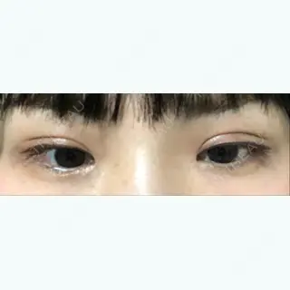 70日目の経過画像（2枚目）