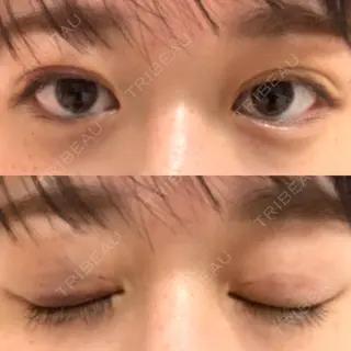 1日目の経過画像（1枚目）