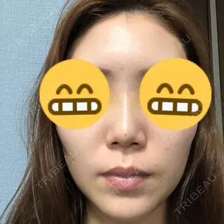 5日目の経過画像（1枚目）