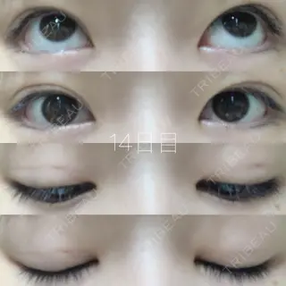 14日目の経過画像（1枚目）
