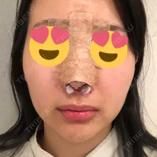 0日目の経過画像（1枚目）