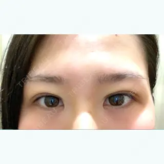 0日目の経過画像（1枚目）
