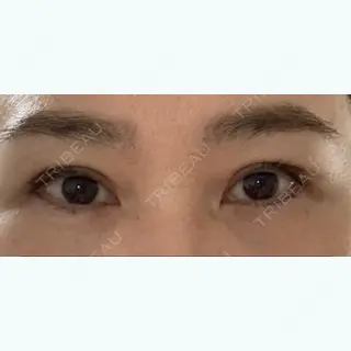 89日目の経過画像（1枚目）