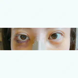3日目の経過画像（1枚目）