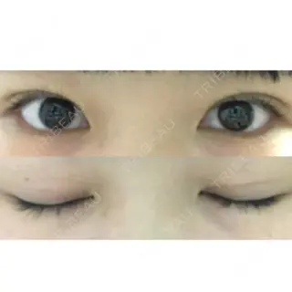 6日目の経過画像（2枚目）
