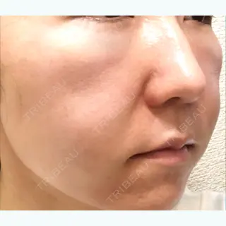 0日目の経過画像（1枚目）