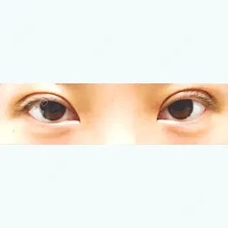 5日目の経過画像（1枚目）