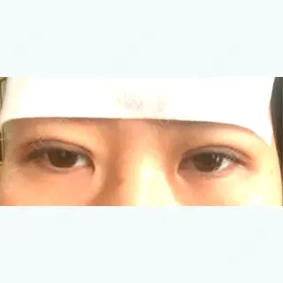 1日目の経過画像（1枚目）