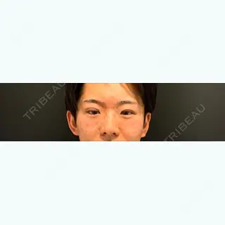 0日目の経過画像（1枚目）