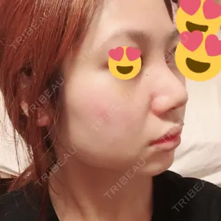 7日目の経過画像（3枚目）