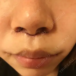 0日目の経過画像（2枚目）