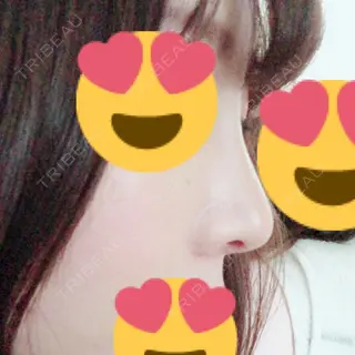 7日目の経過画像（3枚目）