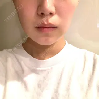 5日目の経過画像（1枚目）
