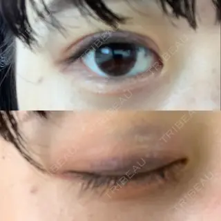 5日目の経過画像（3枚目）