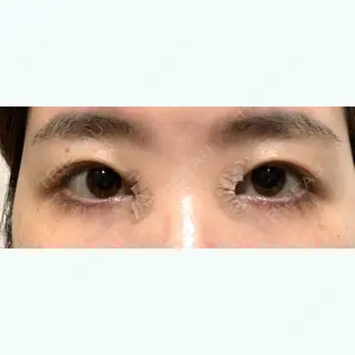 2日目の経過画像（1枚目）