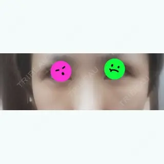 0日目の経過画像（1枚目）